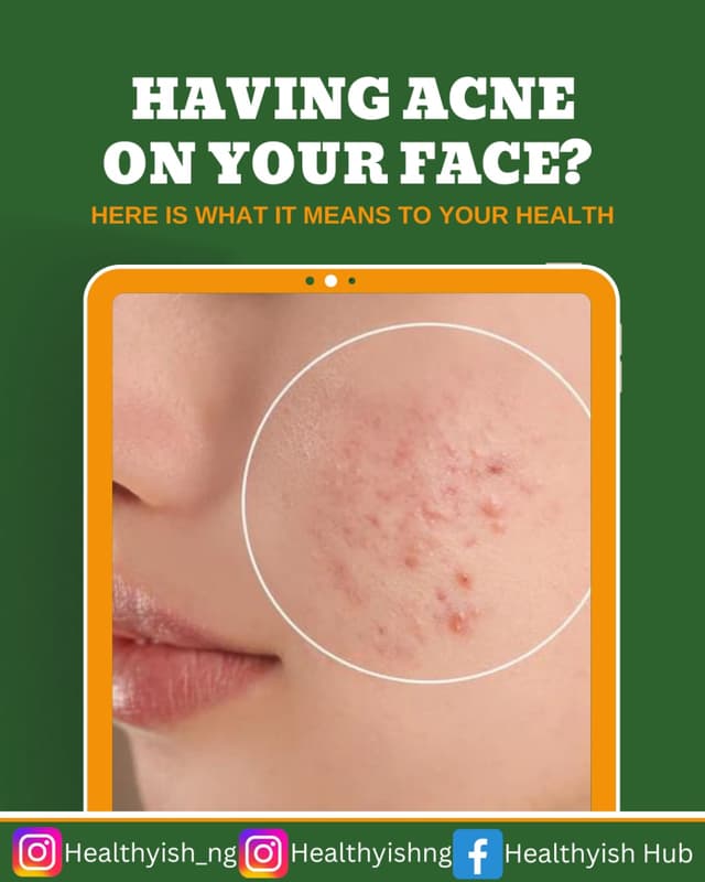 HAVING ACNE ON YOUR FACE? HERE IS WHAT IT MEANS TO YOUR HEALTH
